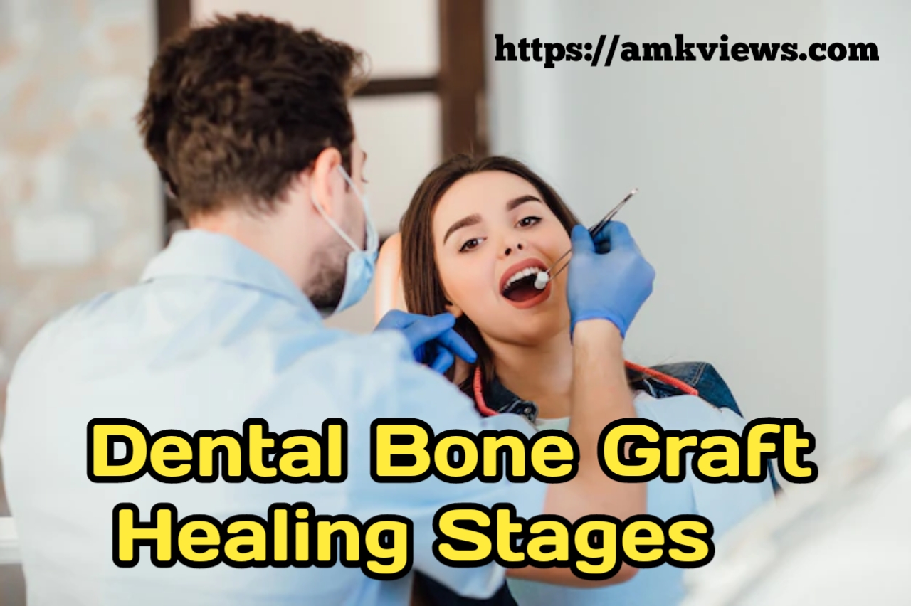 Dental Bone Graft Healing Stages: a Comprehensive Guide