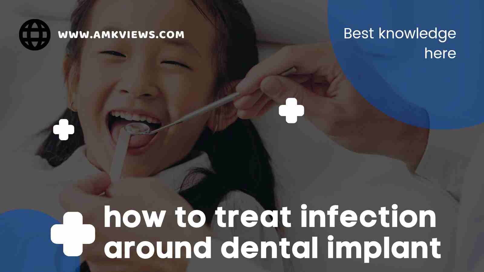 How to Treat Infection Around Dental Implants