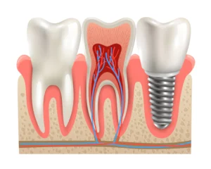 How long does a Root Canal take to Heal?