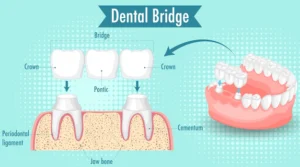 How to Fix a Loose Dental Bridge at Home, Step by Step