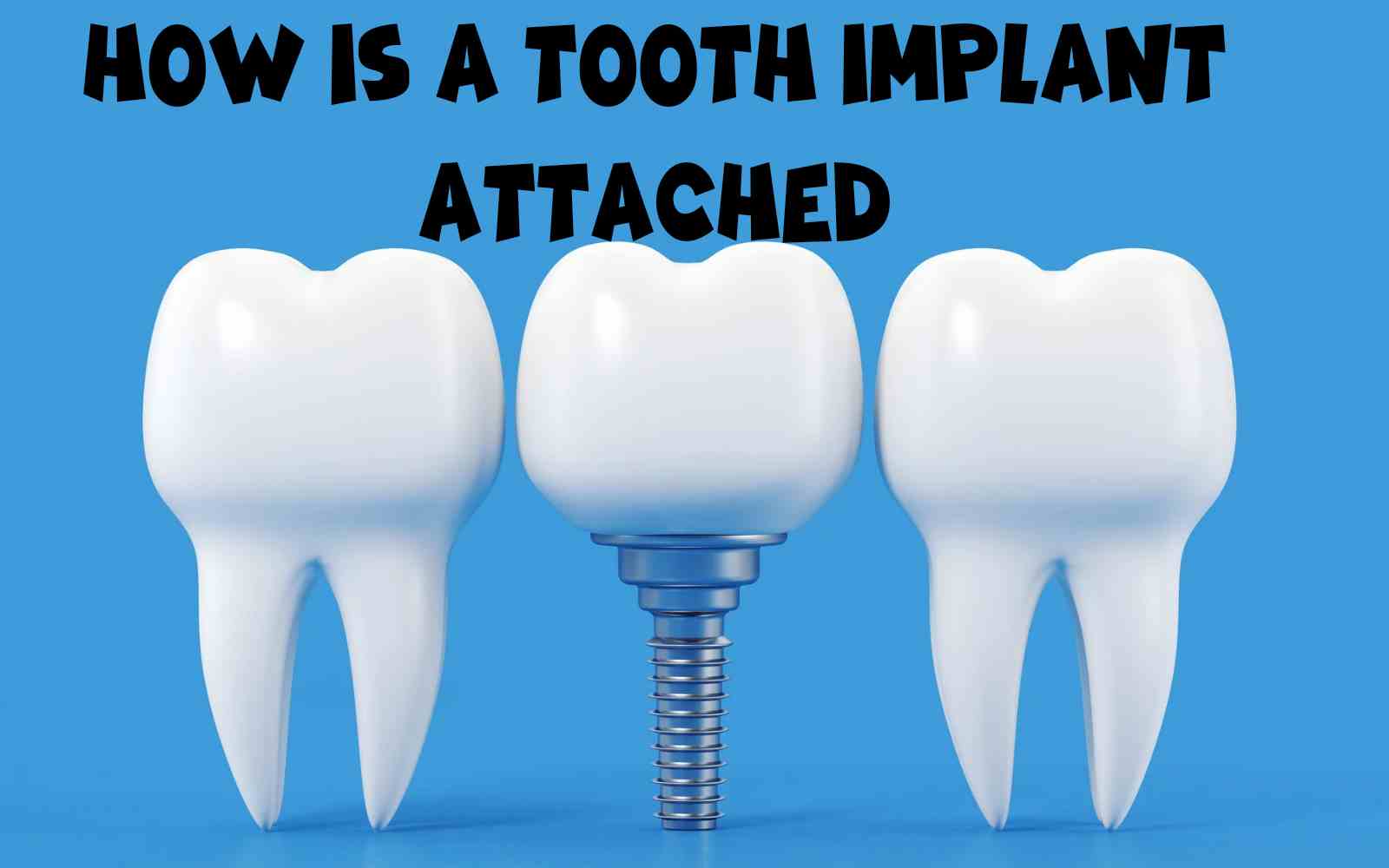 How is a Tooth Implant Attached