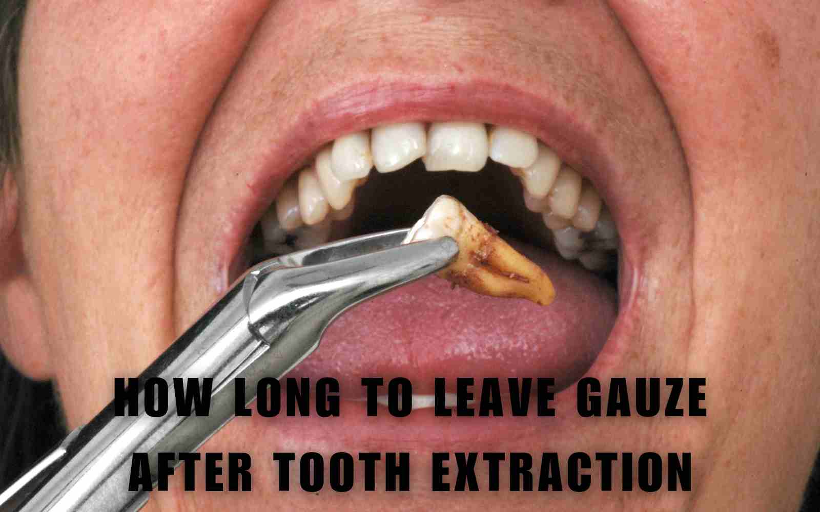 How Long To Leave Gauze After Tooth Extraction