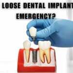 Is a Loose Dental Implant an Emergency