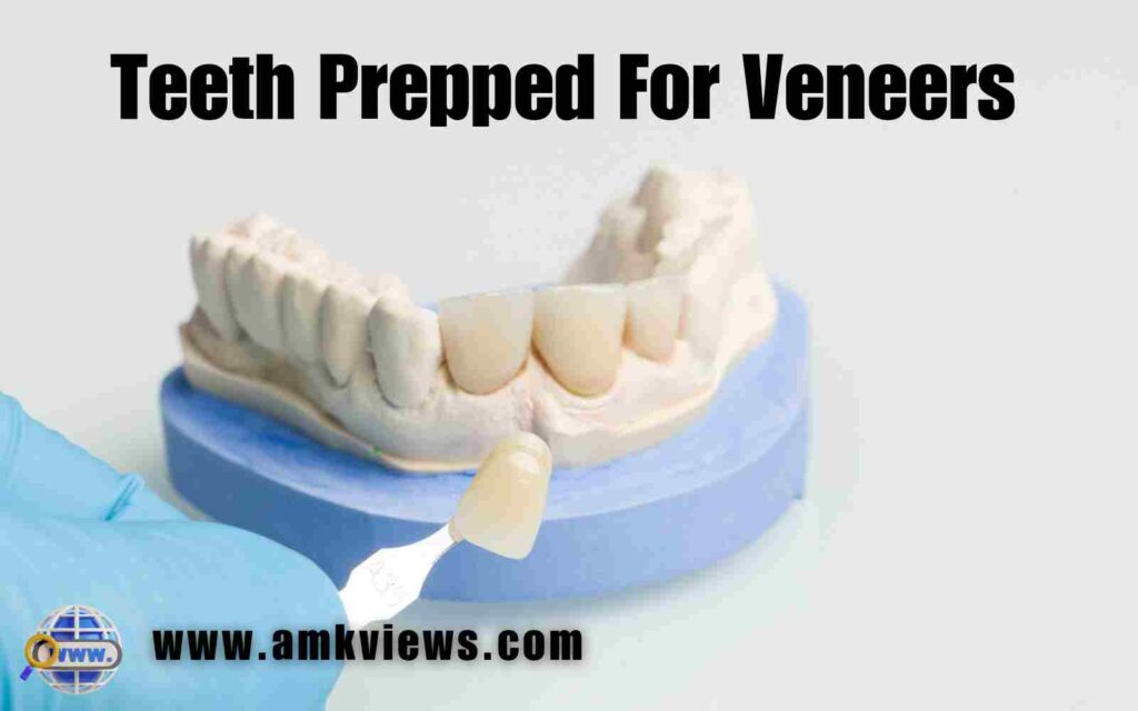Teeth Prepped For Veneers: Comprehensive Guide