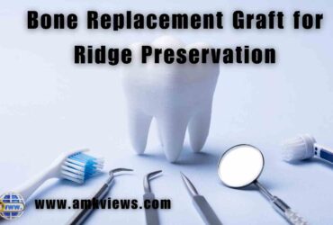 Bone Replacement Graft for Ridge Preservation