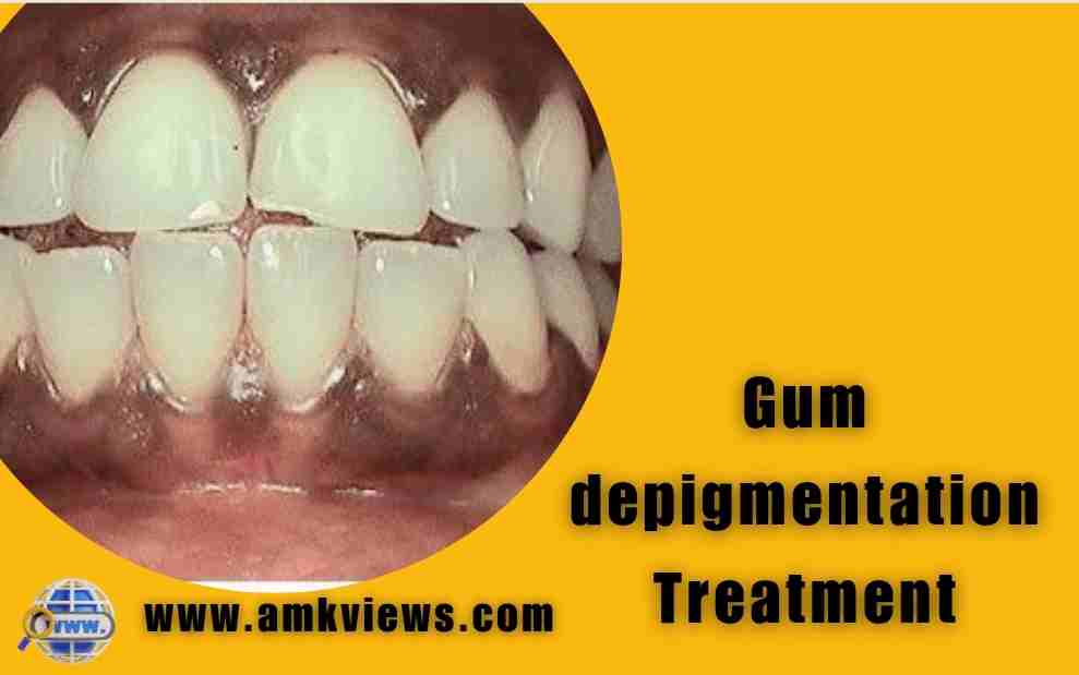 Gum depigmentation Treatment
