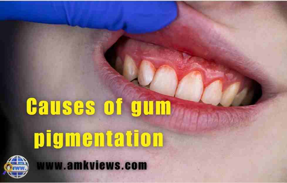 Causes of gum pigmentation