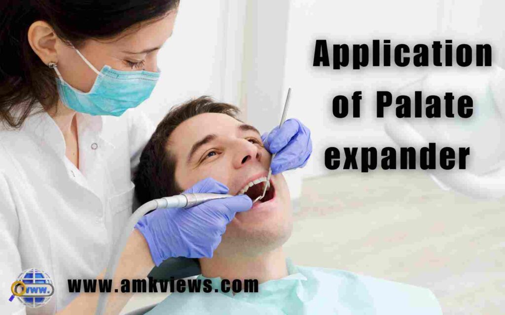 Application of Palate expander 