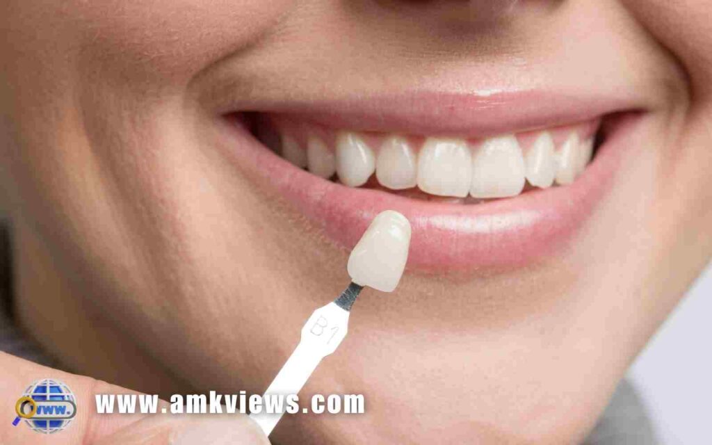 What Do Teeth Look Like Under Veneers?
