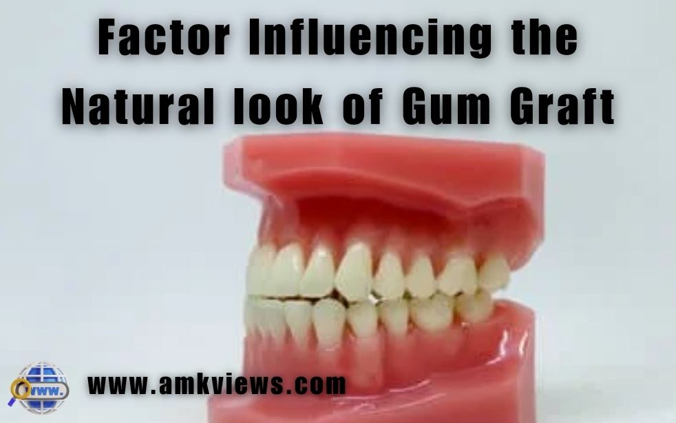 Factor Influencing the Natural look of Gum Graft