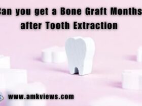 Can you get a Bone Graft Months after Tooth Extraction